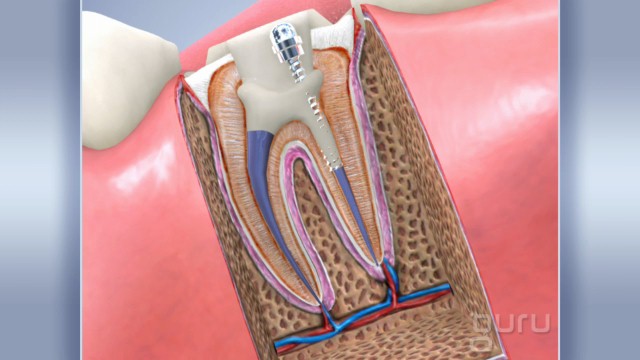 root-canal-treatments-jr-dental-care-jacksonville