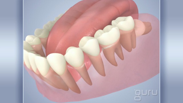 Wisdom Teeth - JR Dental Care Jacksonville